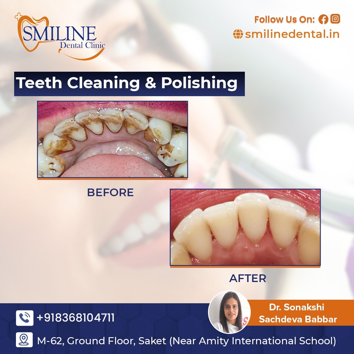 Dental implant procedure at Smiline Dental Clinic Saket South Delhi
